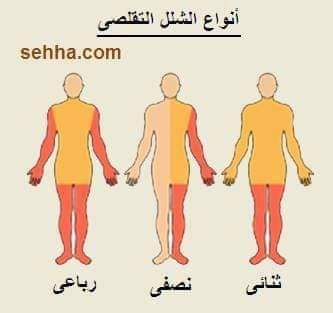 أنواع الشلل الدماغي