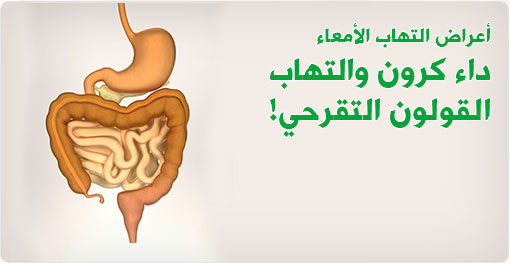 في اليوم العالمي لأمراض الأمعاء المناعية.. إطلاق حملة للتوعية بمرض القولون التقرحي
